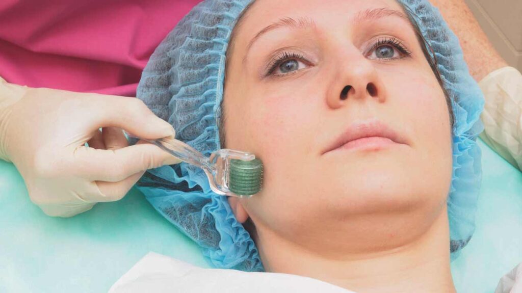 Microneedling for Wrinkles